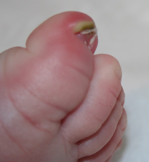 Badly Ingrown Toenail