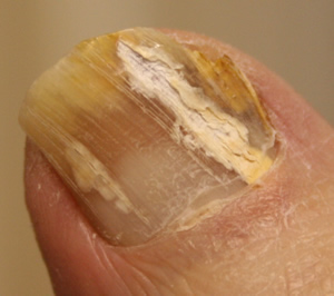 Toenail Fungus Treatment - Natural Organic Home Garden Health Howard ... Toenail Fungus Treatment - Natural