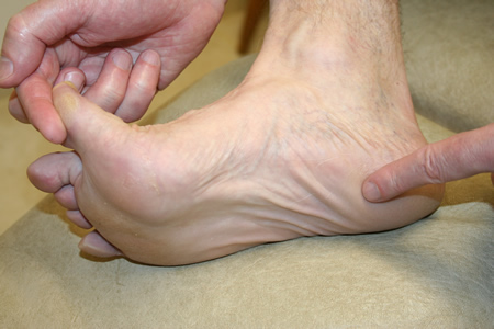 Steroid shots for plantar fasciitis